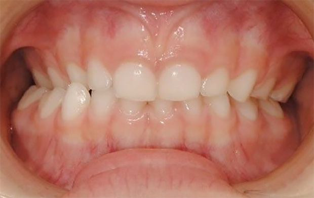 mordida-cruzada-lima-odontologia-artur-nogueira-1516967534